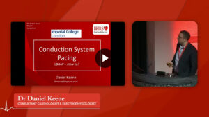 SESSION 2b: Left Bundle Branch Area Pacing, easier than you think - Dr Daniel Keene